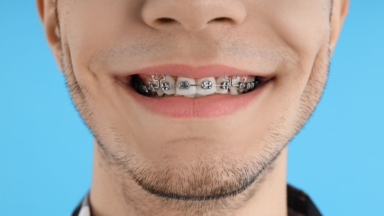 Alinhador transparente invisalign versus aparelho ortodôntico tradicional -  Instituto Caiado - Odontologia