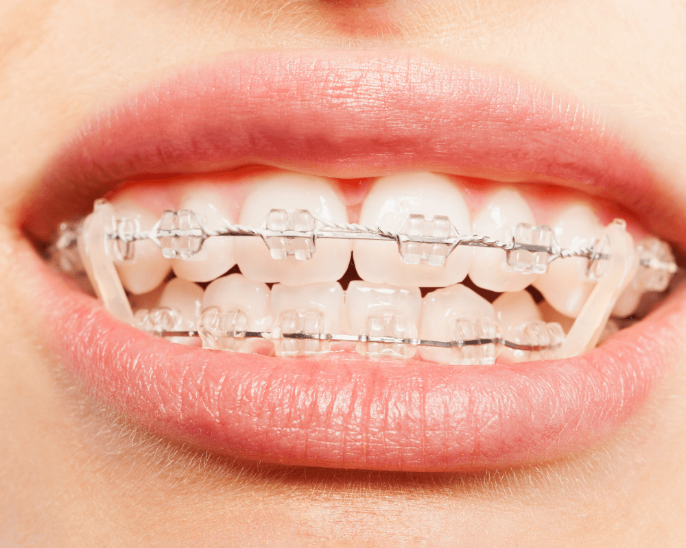 Como funciona o alinhador dental transparente? - Ortodontia Curitiba