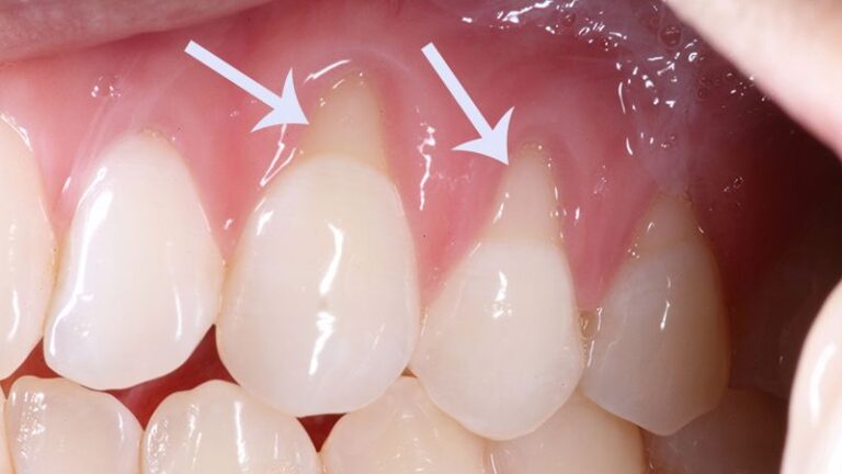Raiz do Dente Exposta: Entenda as Causas - Instituto Caiado - Odontologia