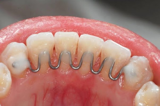 Contenções Ortodônticas