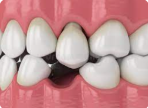 Dente Perdido: Quais São os Riscos de Não Substituir e Como Resolver o Problema.
