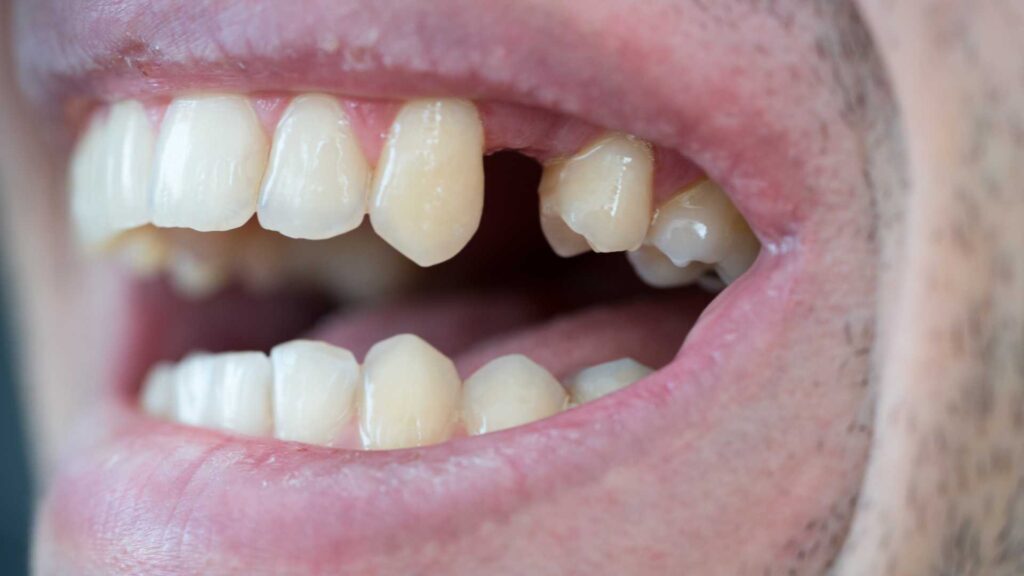Dente Perdido: 
