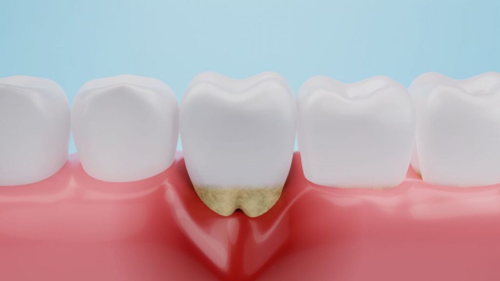 Periodontite Apical 