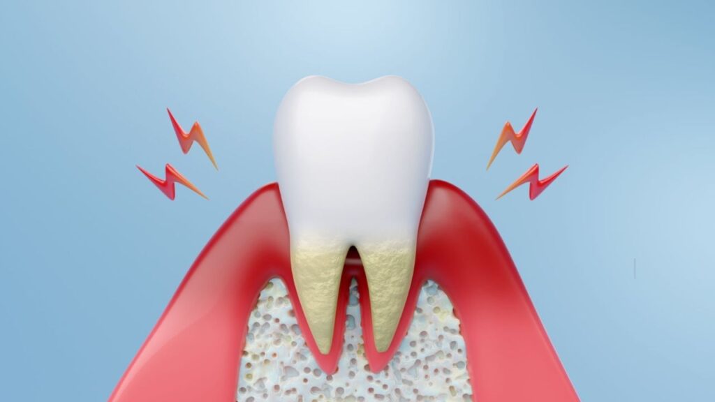 Periodontite Apical 