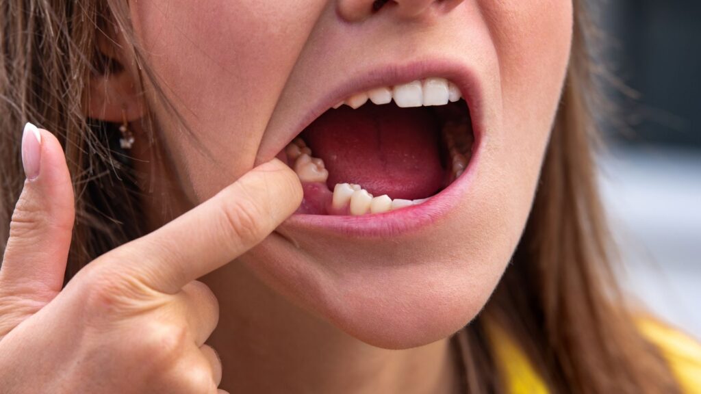 Perda Dentária e Substituição de Dentes Perdidos