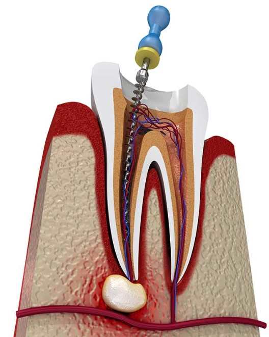 Raiz do Dente Inflamada Sintomas