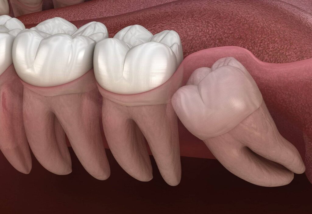 Dente do Siso Inflamado