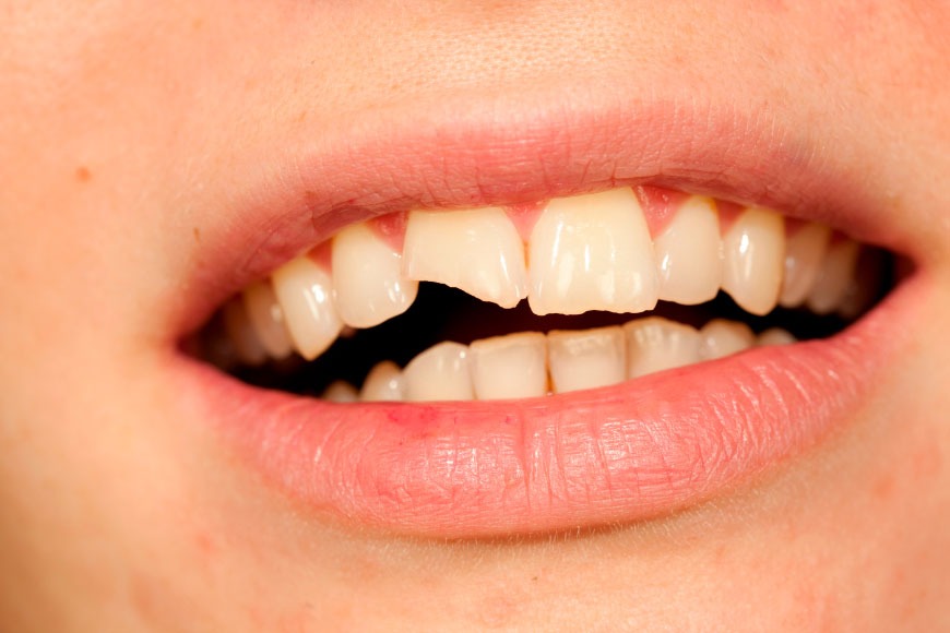 Dentes Fracos: Entenda as Causas