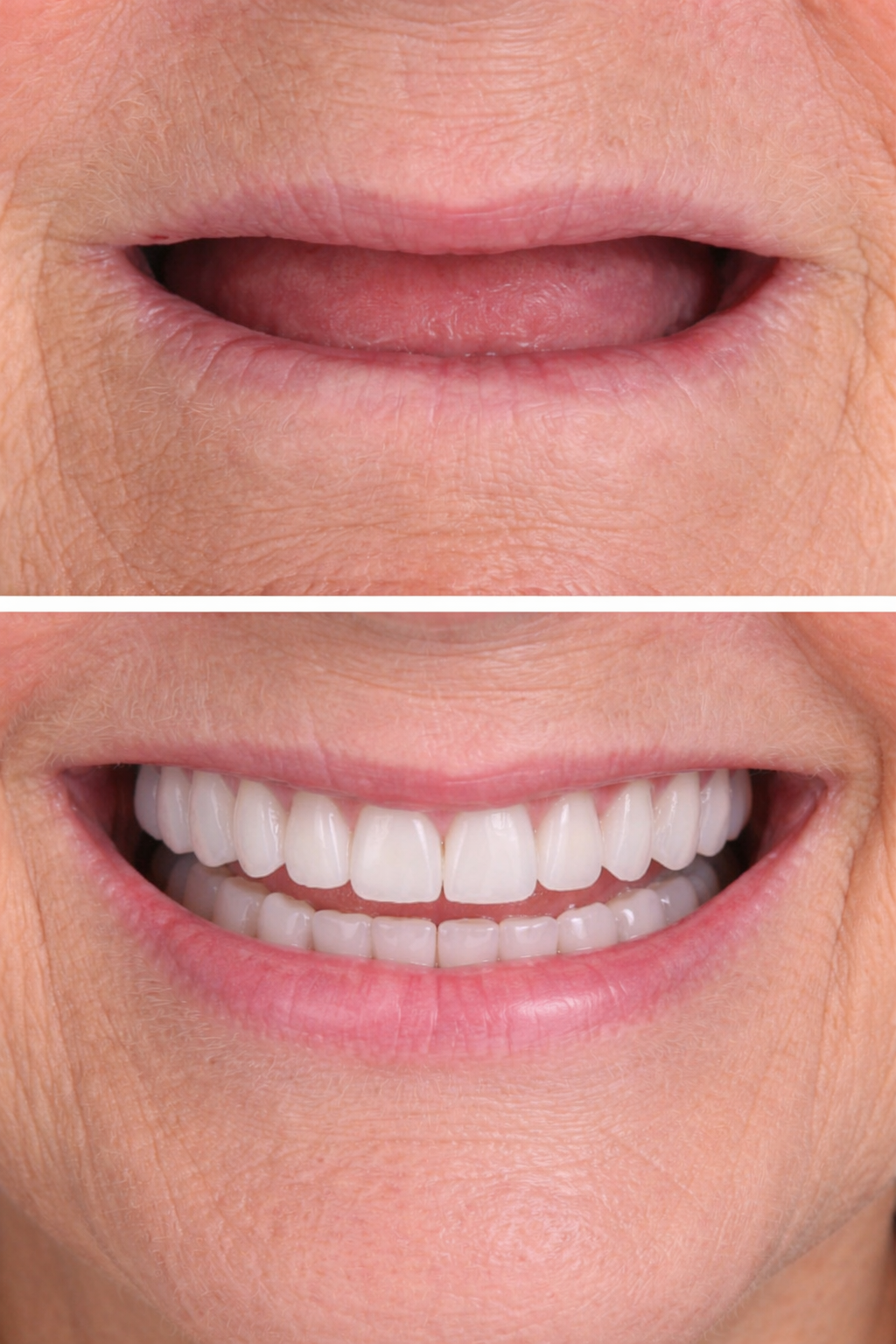 Efeito Colapso Facial: O Risco Oculto de Usar Dentadura por Muitos Anos Sem Implantes.